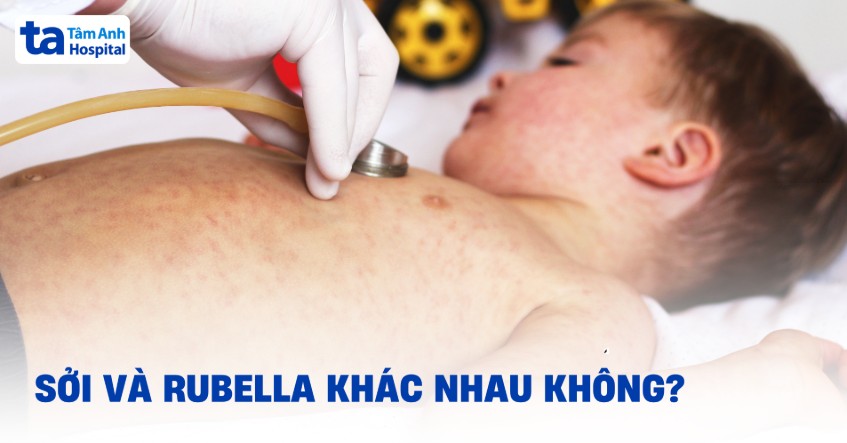 Sởi và Rubella có khác nhau không? Hướng dẫn phân biệt chi tiết