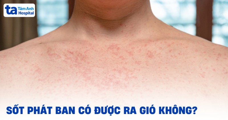Sốt phát ban có được ra gió không? Ra ngoài phải lưu ý gì?