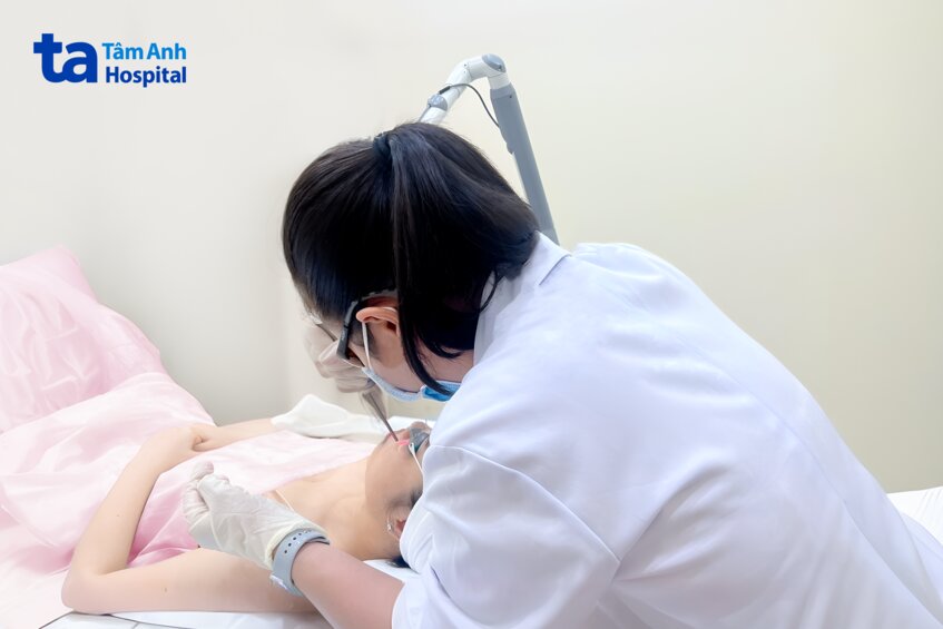 sử dụng laser pico để phá vỡ sắc tố gây thâm