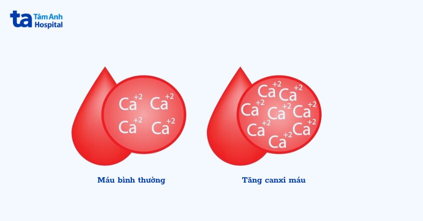 tăng canxi máu là nguyên nhân chính