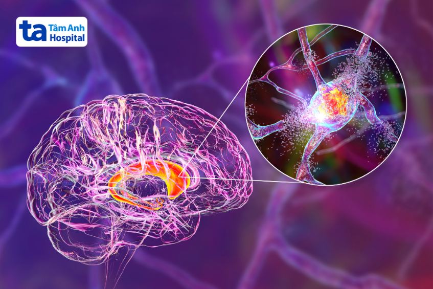 tế bào thần kinh thoái hóa ở bệnh huntington