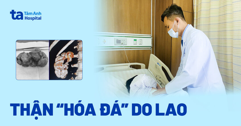 Thận ‘hóa đá’ do lao