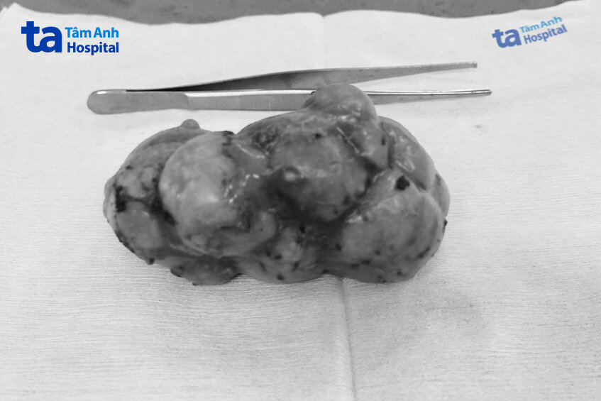 thận hóa đá được gắp ra