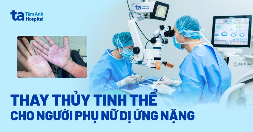 thay thủy tinh thể cho người dị ứng nặng