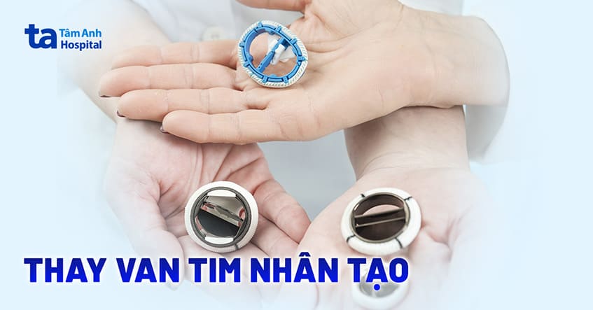 Thay van tim nhân tạo là gì? Quy trình phẫu thuật thế nào?
