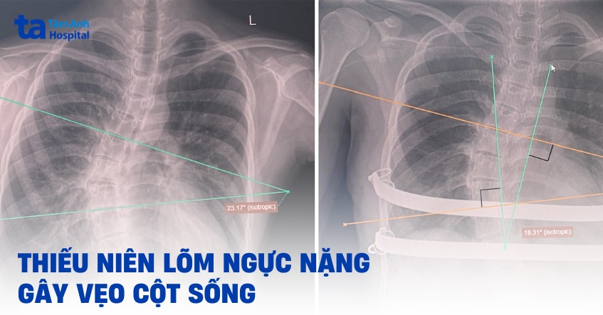 Thiếu niên lõm ngực nặng gây vẹo cột sống