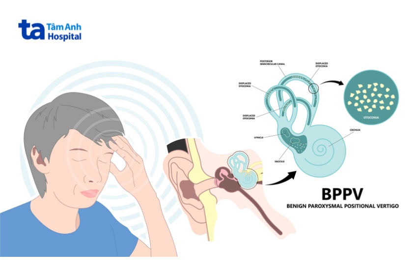 thủ thuật định vị sỏi tai bppv