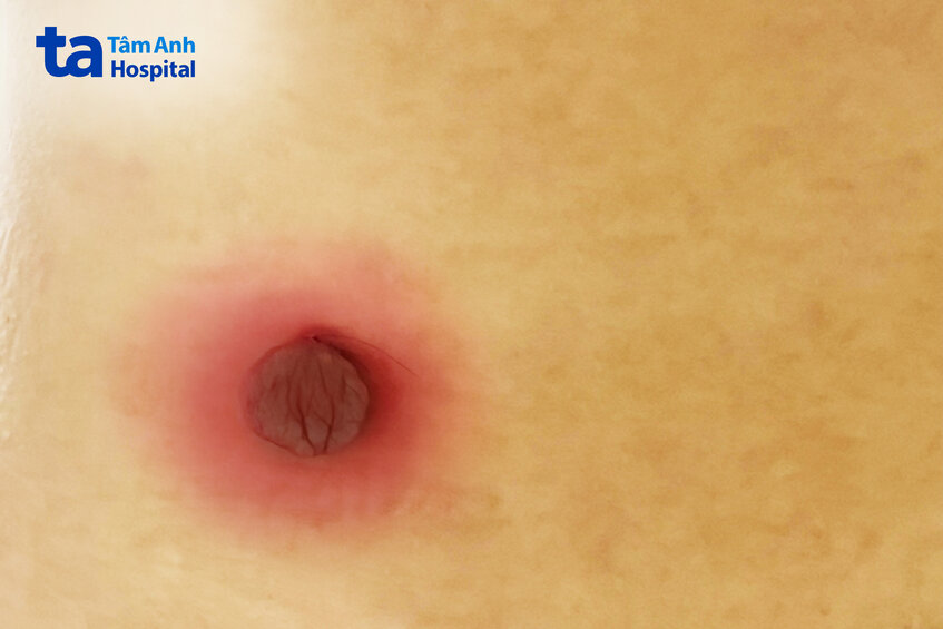 tình trạng khối u của chị tâm