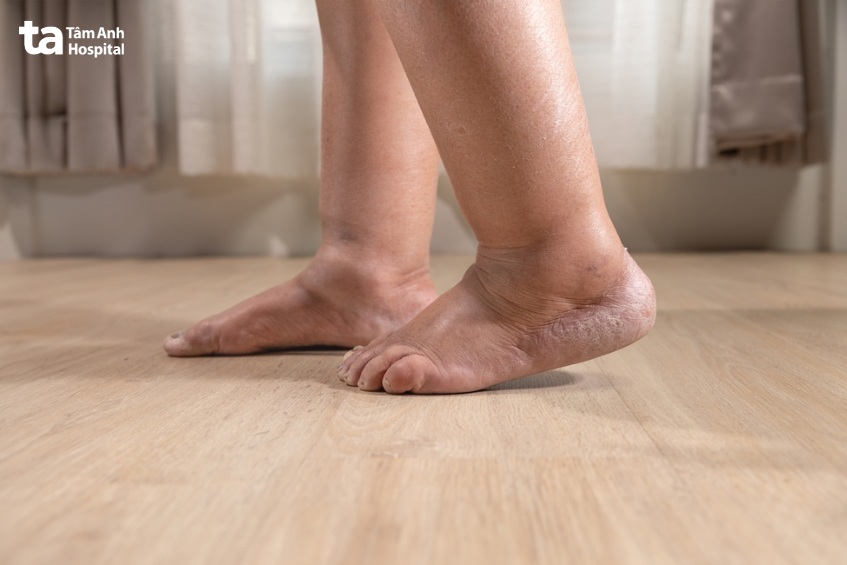 tình trạng phù chân ở người bị ung thư