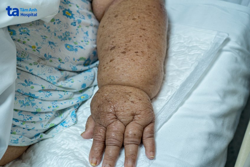 tình trạng phù nề nhiều vị trí