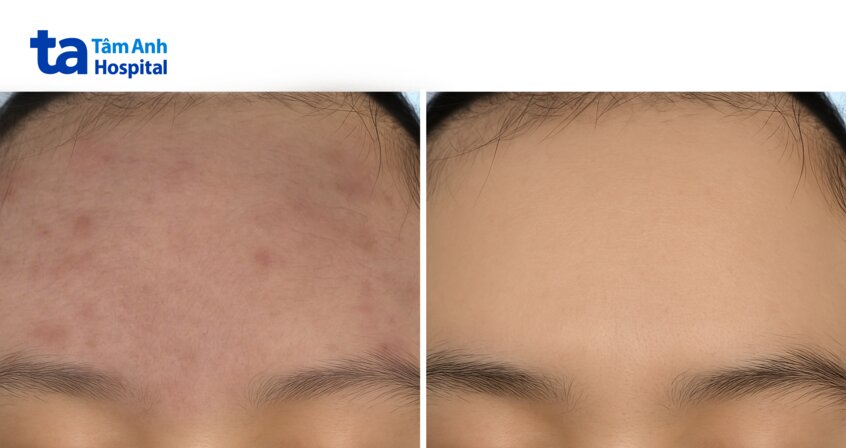 tình trạng thâm cải thiện sau điều trị