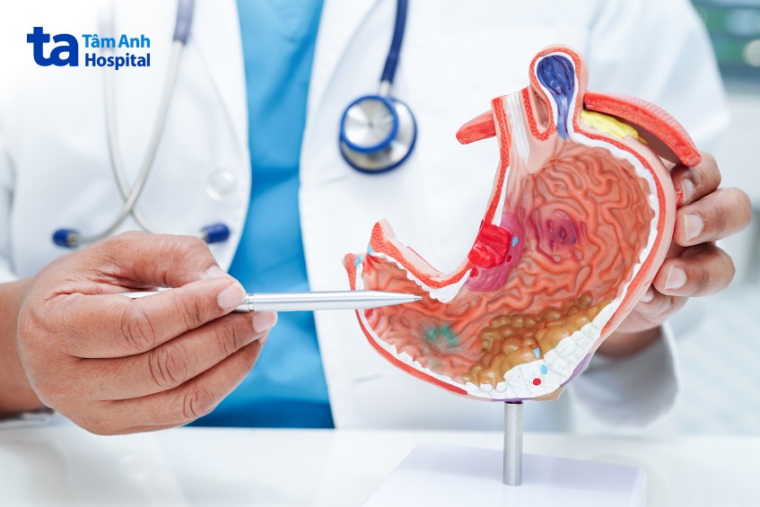 tình trạng ung thư dạ dày ngày càng gia tăng