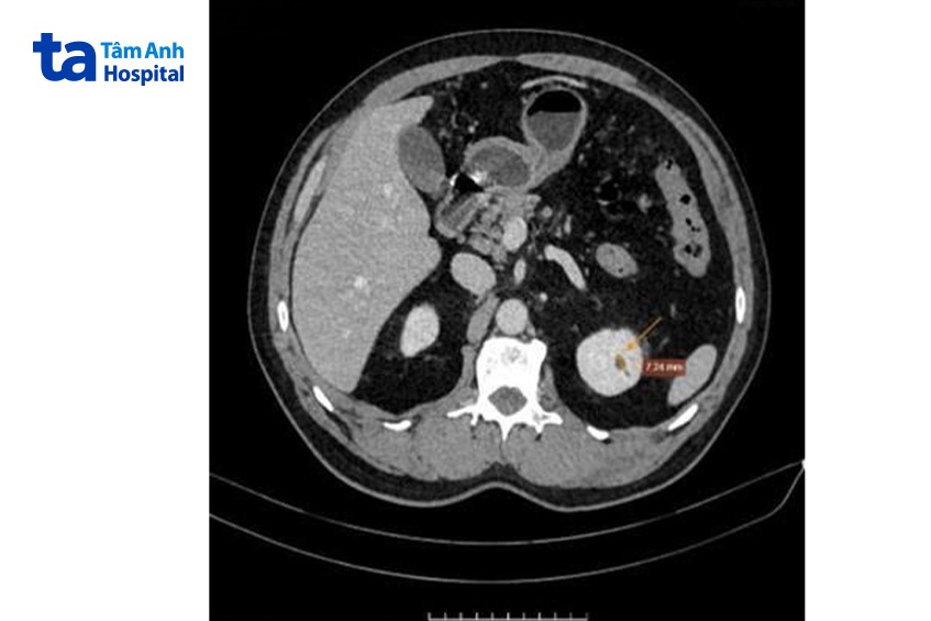 tổn thương đuôi tụy trên ảnh chụp ct