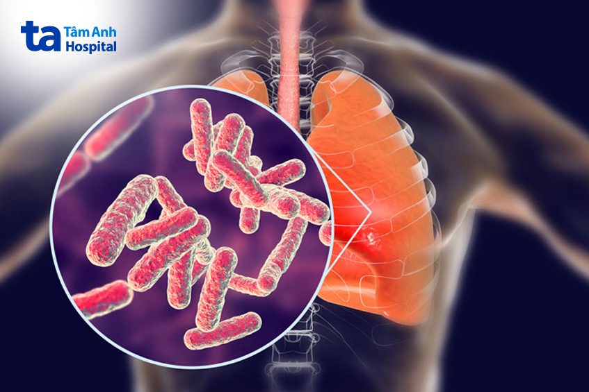 Tràn dịch màng phổi do lao có tỉ lệ người mắc cao hơn