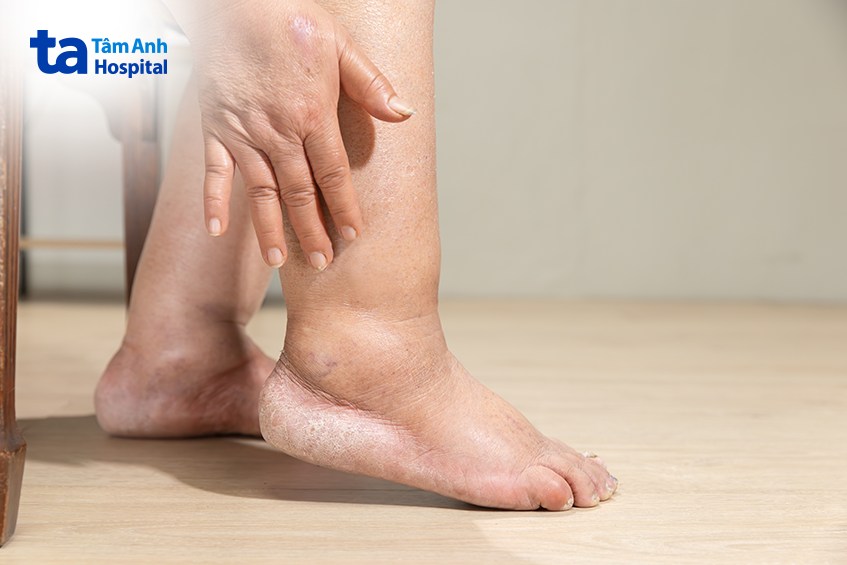 Tràn dịch màng phổi khiến người bệnh gặp tình trạng phù nề