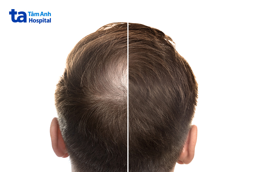 So sánh da đầu trước và sau điều trị rụng tóc bằng liệu pháp laser