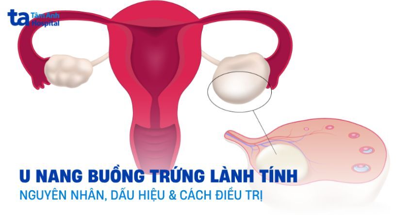 U nang buồng trứng lành tính: Các dấu hiệu và điều trị