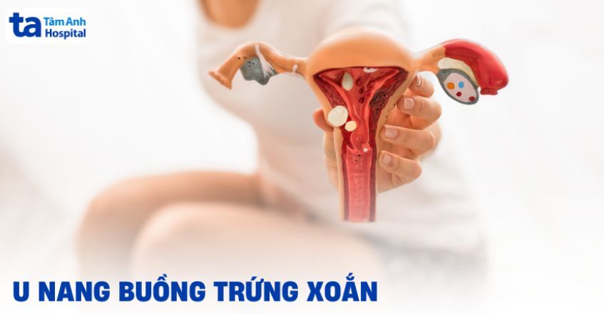U nang buồng trứng xoắn và các lưu ý cần cẩn trọng
