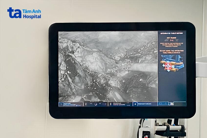 u thận vỡ gây ra tình trạng xuất huyết nghiêm trọng