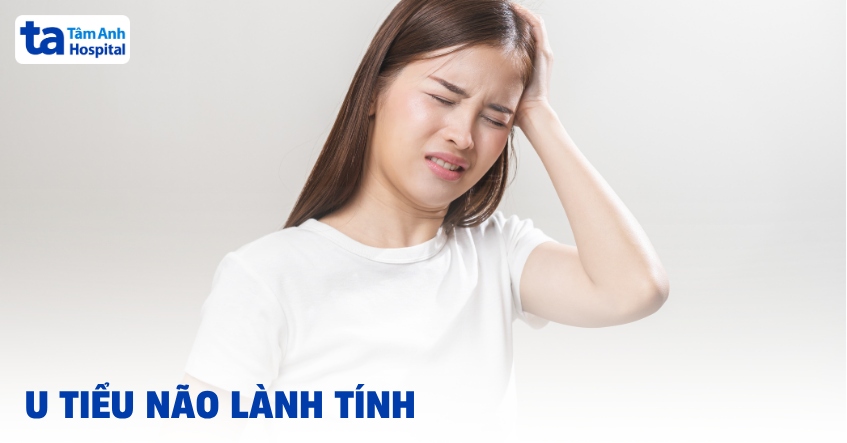 U tiểu não lành tính: Triệu chứng, tiên lượng và cách điều trị