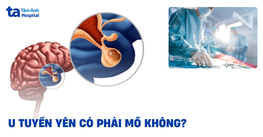 U tuyến yên có phải mổ không? Khi nào được chỉ định phẫu thuật?