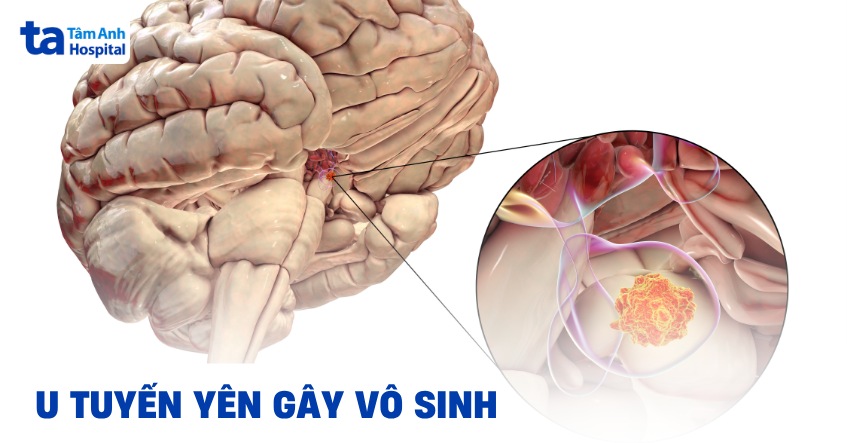U tuyến yên gây vô sinh không? Điều trị tình trạng như thế nào?