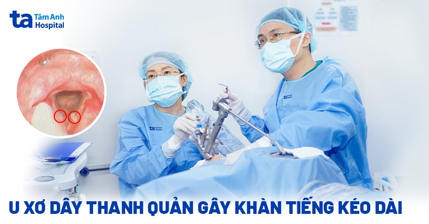 U xơ dây thanh quản gây khàn tiếng, khàn giọng kéo dài