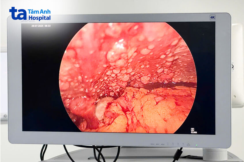 ung thư di căn ở bụng