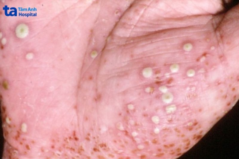 thể mụn mủ khu trú ở bàn tay