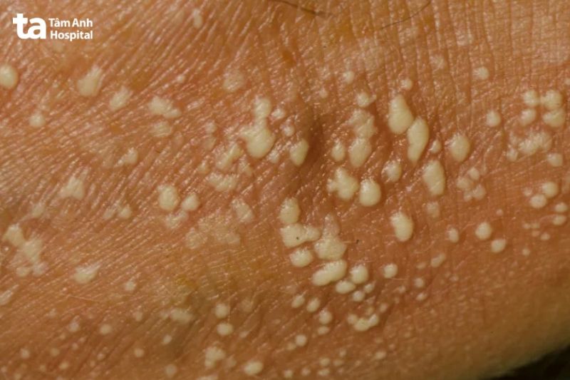 mụn mủ mọc đau rát kèm mảng đỏ