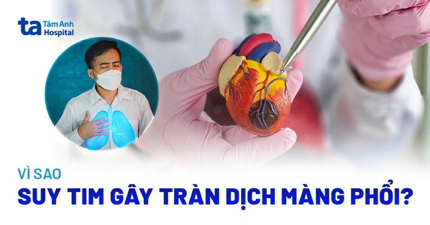 Vì sao suy tim gây tràn dịch màng phổi? Cách điều trị an toàn