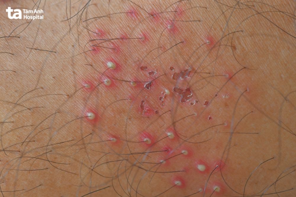 các nốt sần nhỏ màu đỏ khi bị viêm