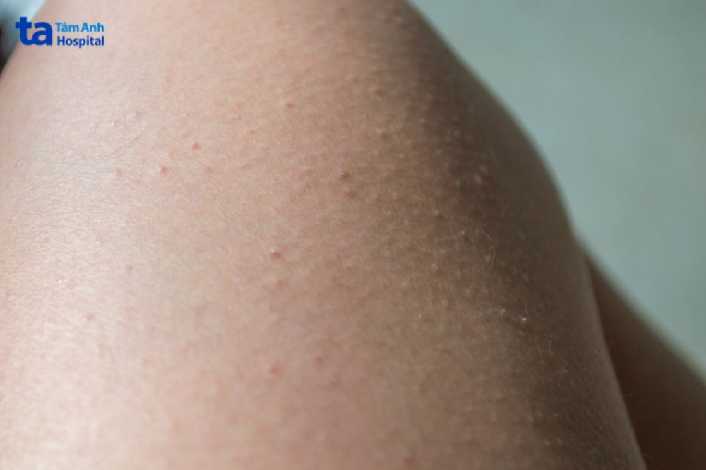 vùng da bị viêm trở nên sần sùi