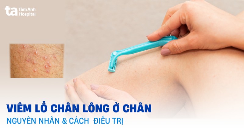 Cách trị viêm lỗ chân lông ở chân tại nhà và nguyên nhân cụ thể