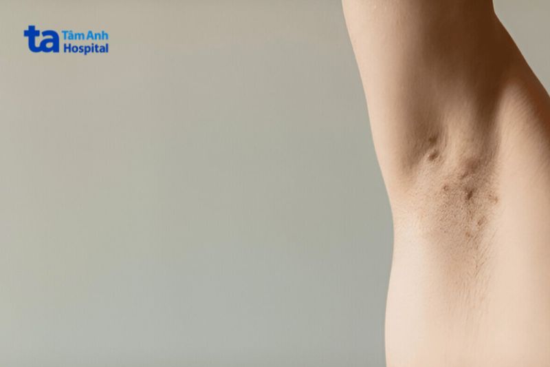 viêm lỗ chân lông ở nách có thể xuất hiện vết mụn thâm