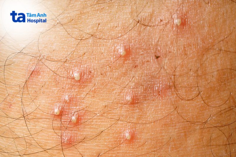 mụn mủ xuất hiện quanh lỗ chân lông nách