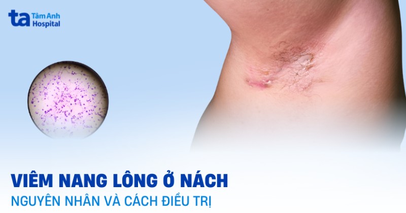 Nguyên nhân gây viêm nang lông nách và cách điều trị