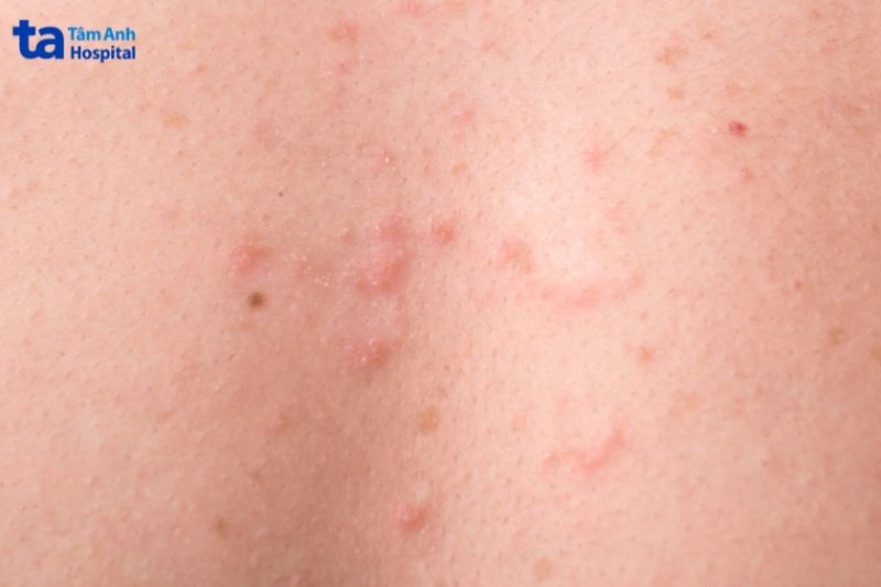 nang lông dạng nhẹ nổi đốt đỏ mủ li ti