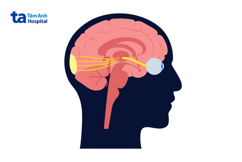 viêm nhiễm ở dây thần kinh vận nhãn