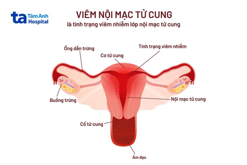 Viêm nội mạc tử cung là một trong những nguyên nhân dẫn đến vô sinh