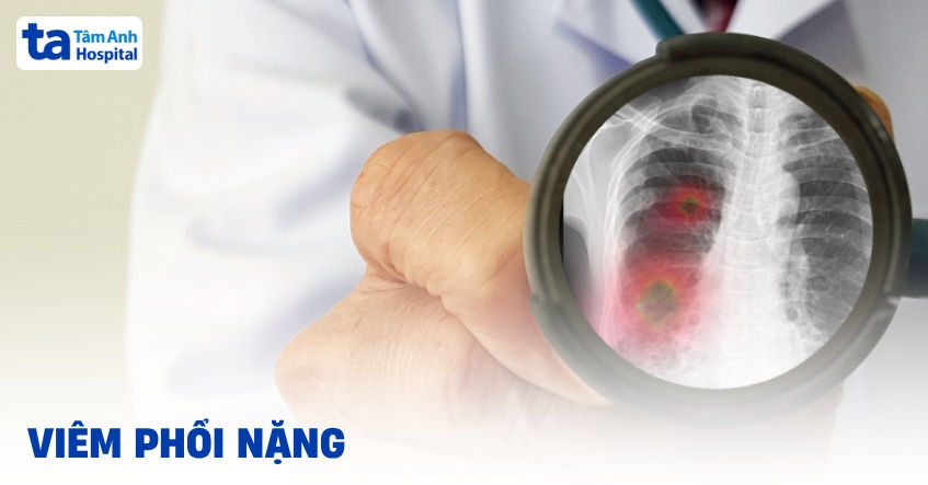 Viêm phổi nặng có nguy hiểm không? Dấu hiệu và cách chẩn đoán