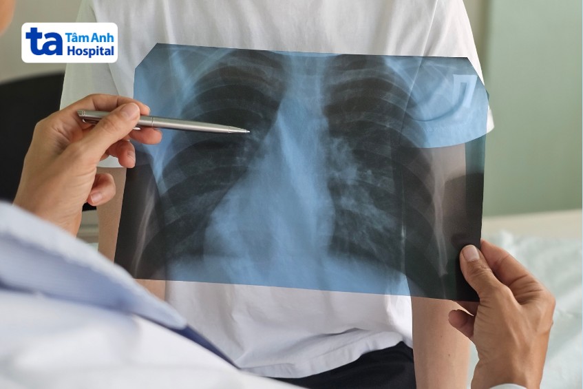 viêm phổi trên xquang