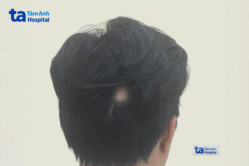 vùng hói đầu nhìn từ phía sau