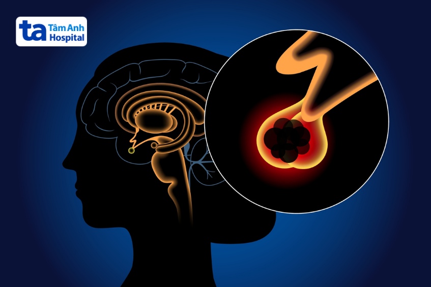 xem xét loại khối u để căn nhắc mổ