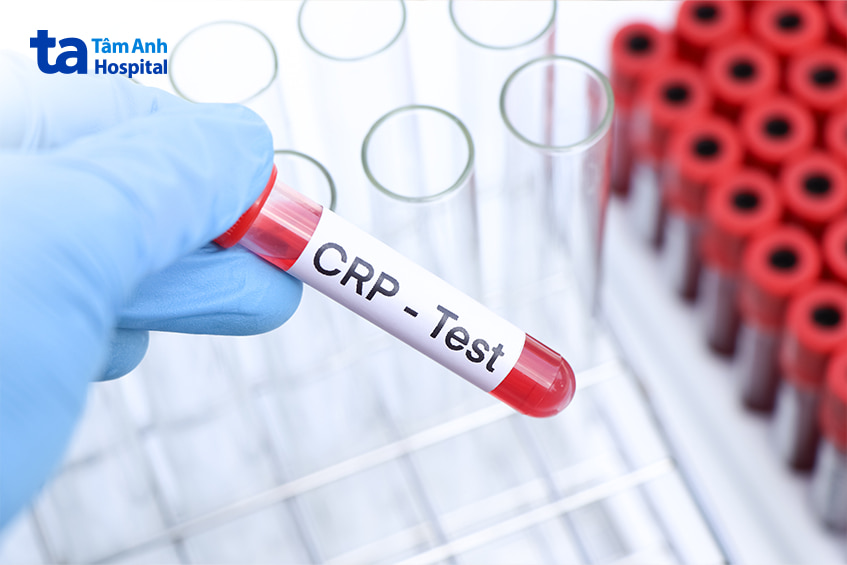 Ống nghiệm xét nghiệm CRP trong chẩn đoán viêm da hoặc phản ứng dị ứng