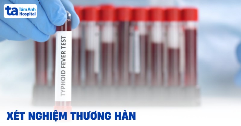 Xét nghiệm thương hàn là gì? Khi nào cần thực hiện?