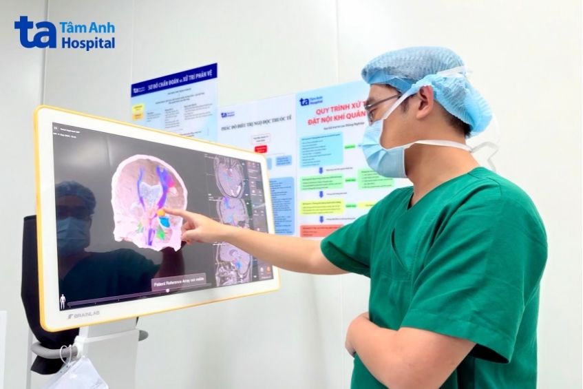Bác sĩ dựng hình 3D trước mổ để xác định chính xác vị trí ổ động kinh của anh Khang.