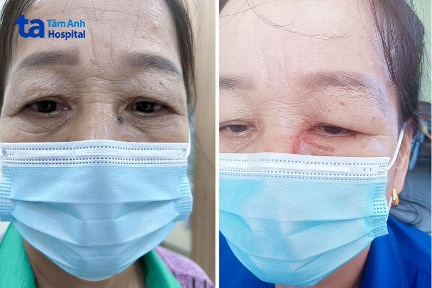 Gương mặt của bà Hằng trước và sau khi được phẫu thuật điều trị ung thư da.