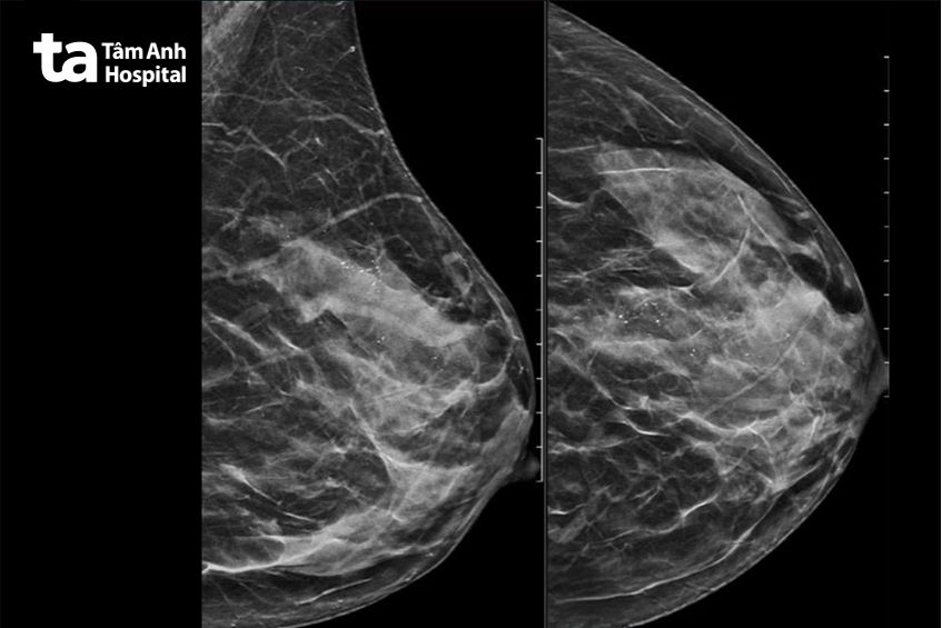 Kết quả chụp nhũ ảnh của bệnh nhân Hồng.
