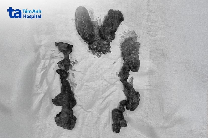 Khối u và hạch bạch huyết được bác sĩ Huân phẫu thuật loại bỏ trong cuộc mổ của bệnh nhân Tùng.